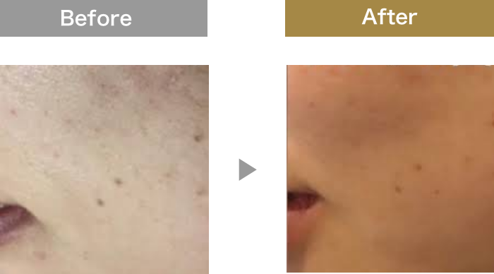 ハーブピーリングプログラム